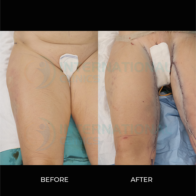 Mini Thigh Lift Before and After Images